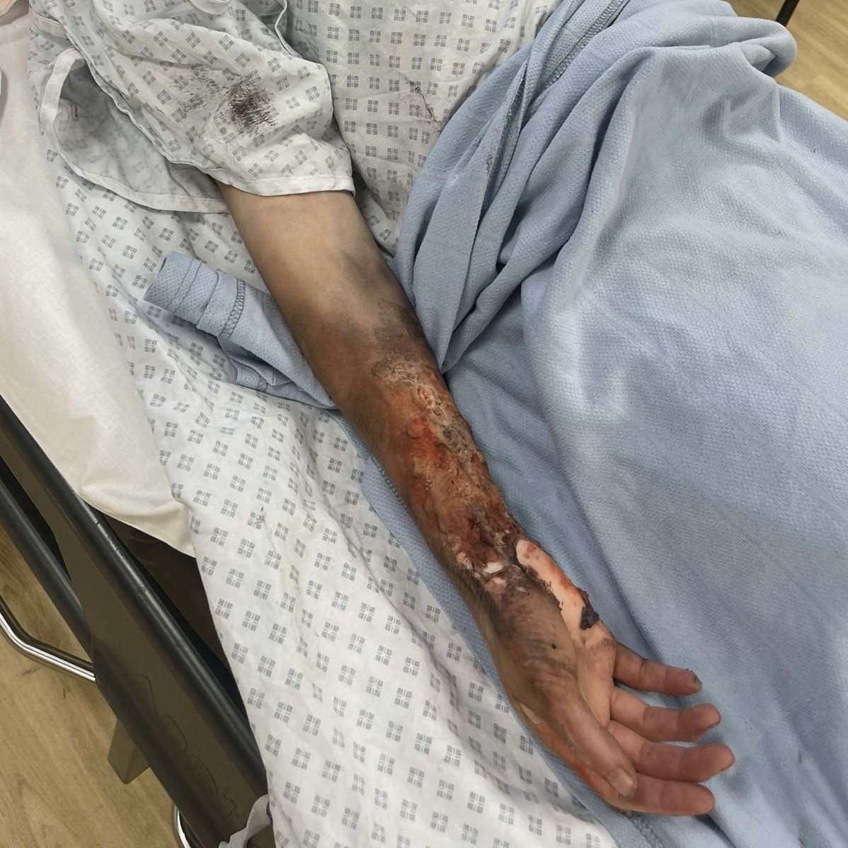 SFX Burn Makeup on student's arm for Trauma Simulation Training